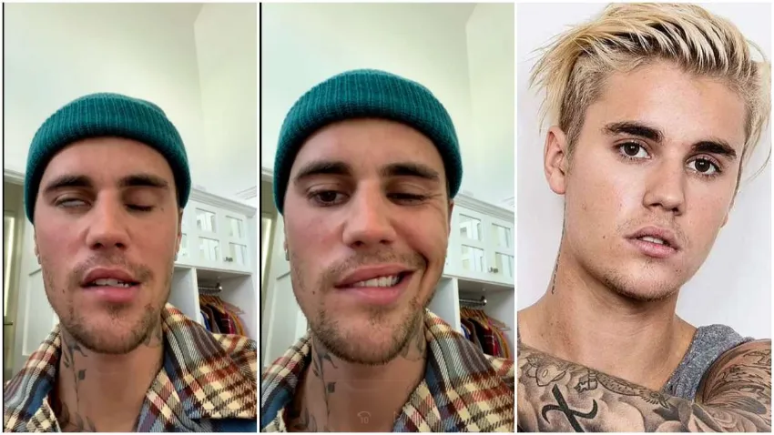 Justin Bieber son halini paylaştı: Yüz felci geçirdim